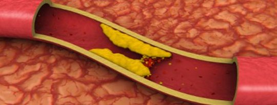 high blood cholesterol high blood cholesterol